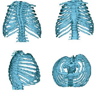 Imagen de análisis estadístico en 3D de la deformidad torácica causada por la Osteogenesis imperfecta que dificulta la capacidad de los pacientes para respirar. // Laboratorio de Morfología Virtual del MNCN