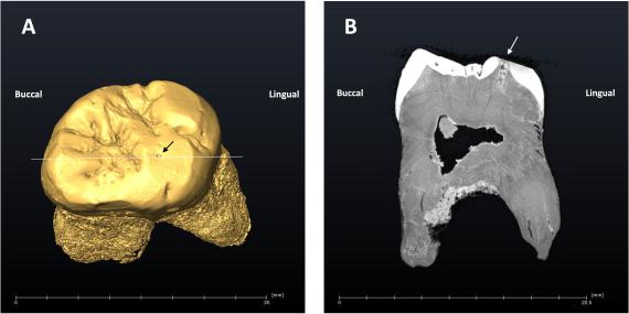 Reconstrucción virtual del diente del Neandertal de El Sidrón con la caries, indicada con una flecha